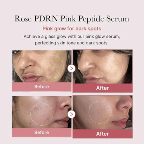 Before and after effects of Rose PDRN Pink Peptide Serum on skin with dark spots.