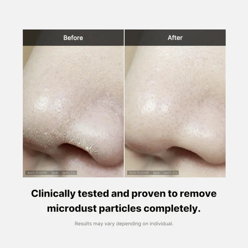 Before and after comparison of a nose with text indicating microdust particle removal.
